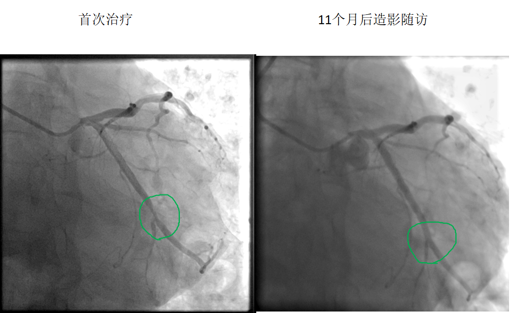 药物球囊治疗原位病变(图1)