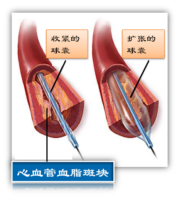 什么是球囊？(图1)