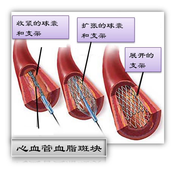 什么是支架？(图1)